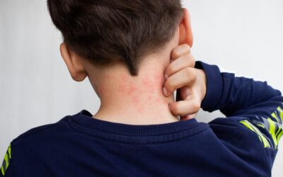 What Does a Food Allergy Test Check For? A Guide to Blood Panels and Sensitivities
