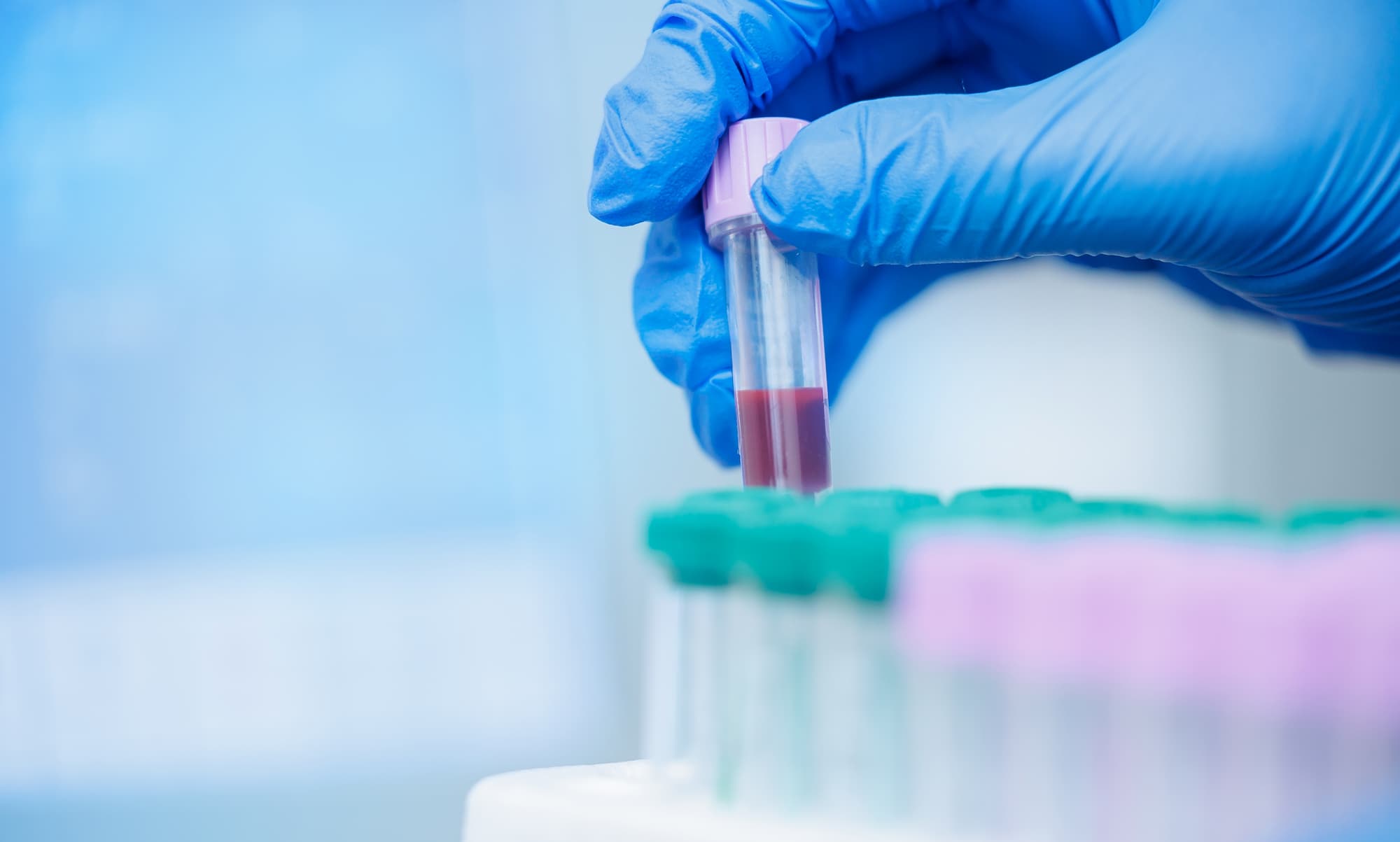 Gloved hand holding a blood sample vial in a laboratory setting for a PEth alcohol test at ARCpoint Labs of Omaha Gloved hand holding a blood sample vial in a laboratory setting for a PEth alcohol test at ARCpoint Labs of Omaha
