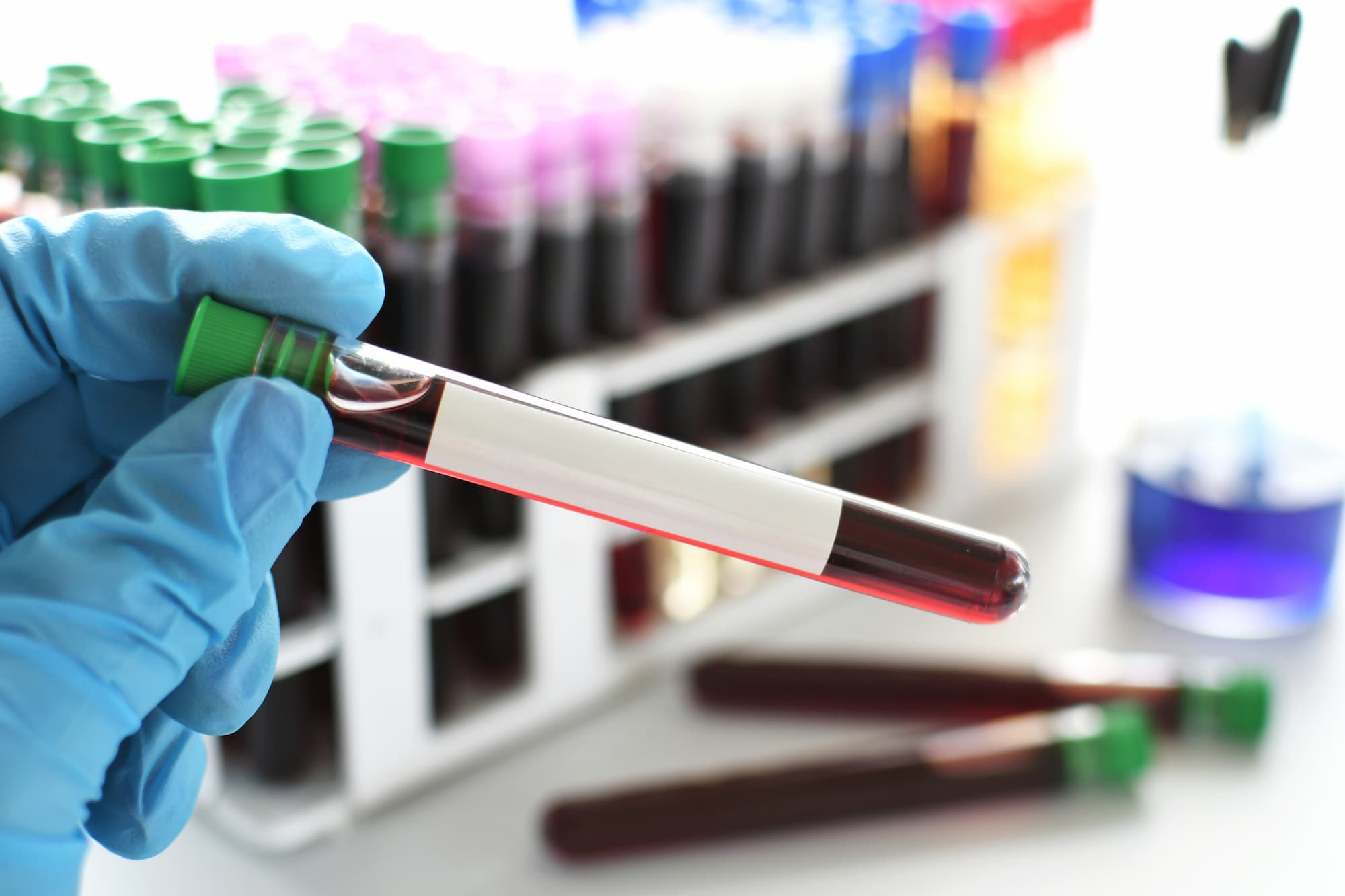 Gloved hand holding a blood test vial in a laboratory setting for baseline hormone panel testing at ARCpoint Labs of San Rafael Gloved hand holding a blood test vial in a laboratory setting for baseline hormone panel testing at ARCpoint Labs of San Rafael