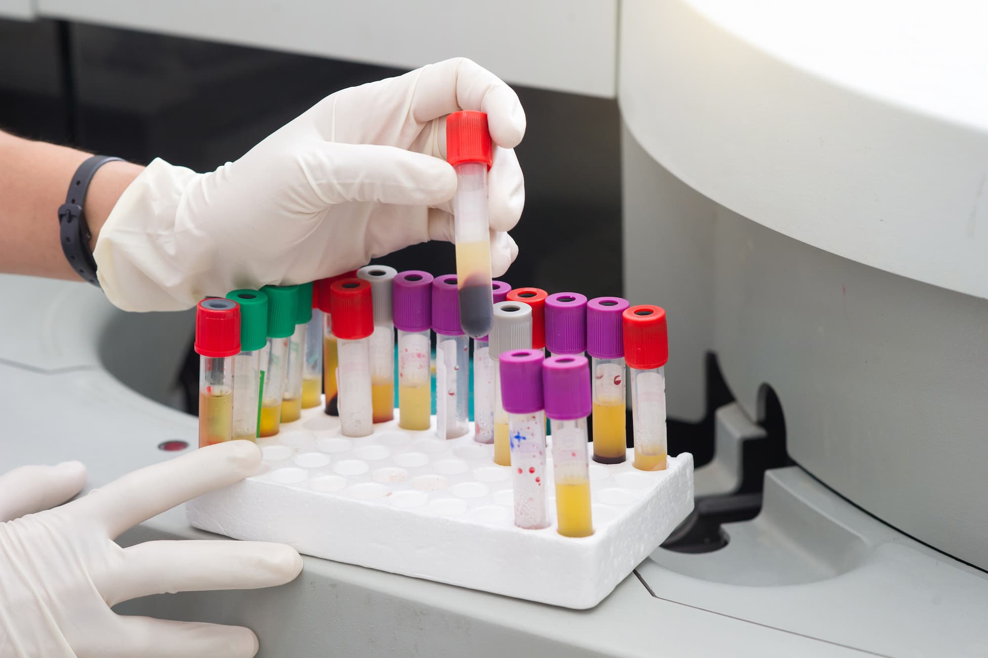 A lab technician wearing white gloves holds a red-capped blood sample tube over a rack of blood samples for STD testing. A lab technician wearing white gloves holds a red-capped blood sample tube over a rack of blood samples for STD testing.